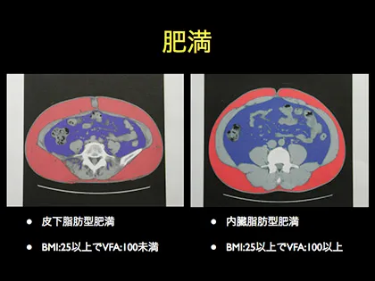 皮下脂肪型肥満と内臓脂肪型肥満